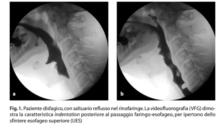 Videofluorografia della deglutizione, esame radiologico essenziale per la valutazione strumentale e la diagnosi precisa della disfagia.